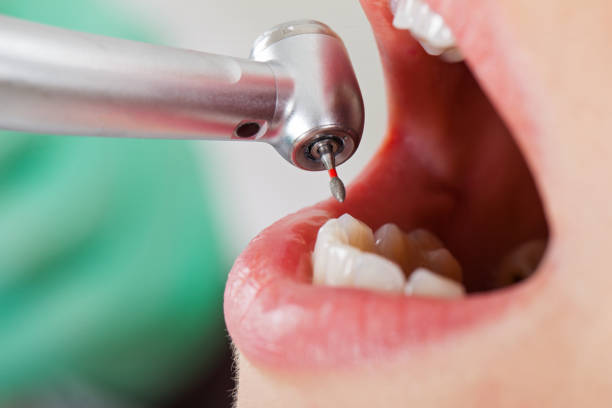Best Emergency Dental Care for Broken or Chipped Teeth in Brighton, MI